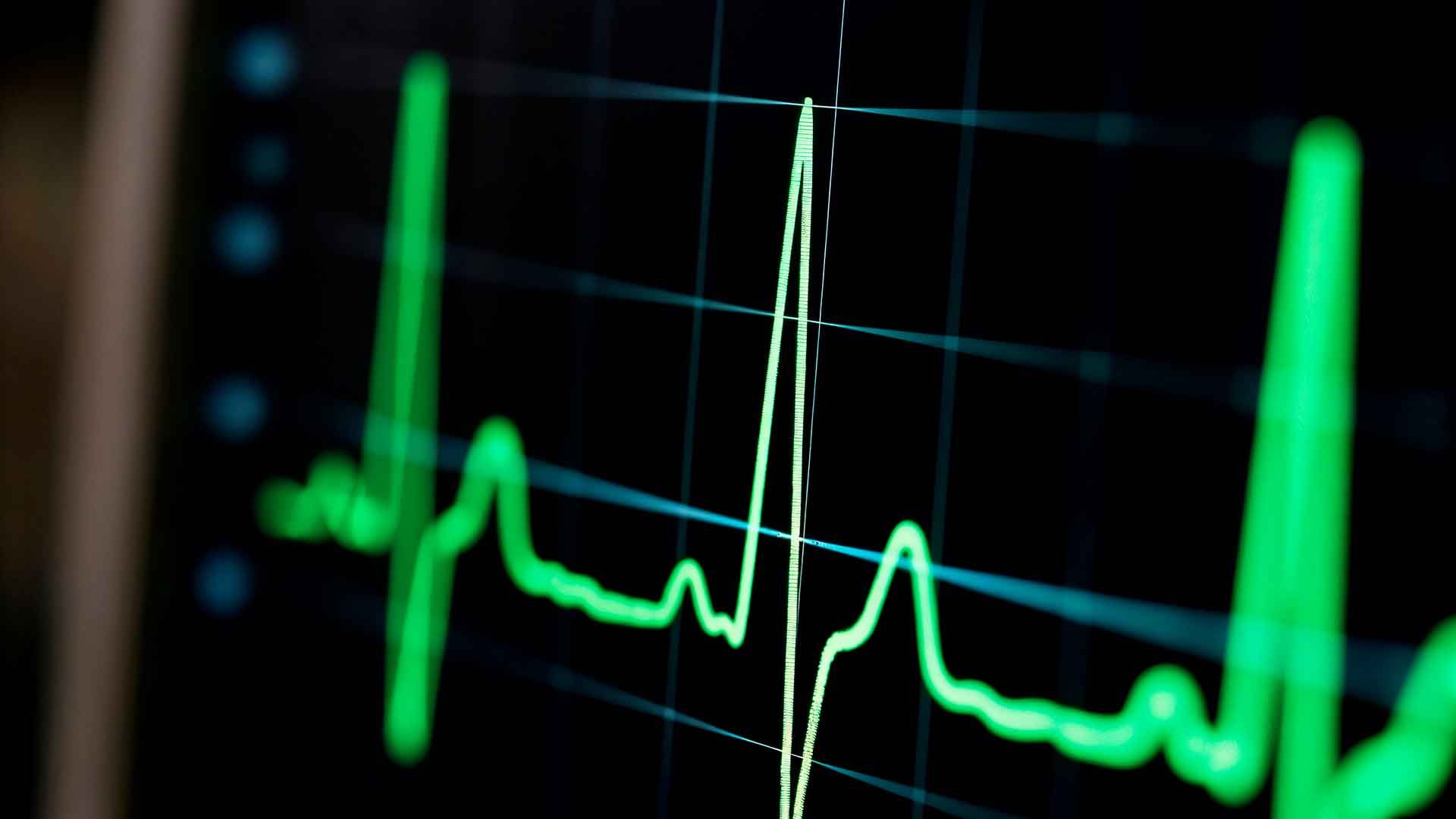 Electrocardiograma